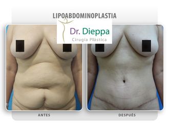 Abdominoplastia - Cirugía Plástica Dieppa