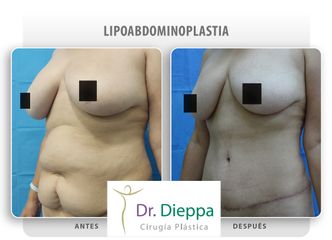 Abdominoplastia - Cirugía Plástica Dieppa