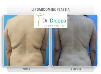 Abdominoplastia - Cirugía Plástica Dieppa