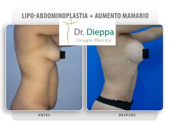 Abdominoplastia - Cirugía Plástica Dieppa