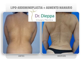 Abdominoplastia - Cirugía Plástica Dieppa