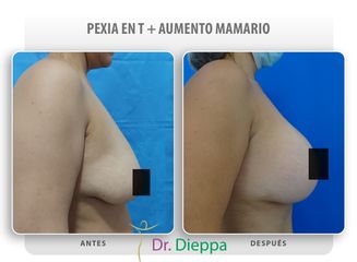Pexia en T + aumento mamario - Cirugía Plástica Dieppa