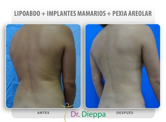Liposucción - Cirugía Plástica Dieppa