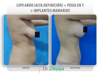 Abdominoplastia - Cirugía Plástica Dieppa
