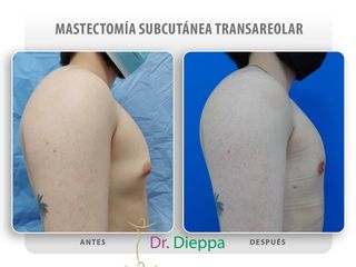 Ginecomastia - Cirugía Plástica Dieppa