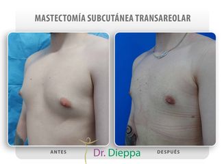 Ginecomastia - Cirugía Plástica Dieppa