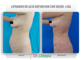 Lipo-abdominoplastia - Cirugía Plástica Dieppa