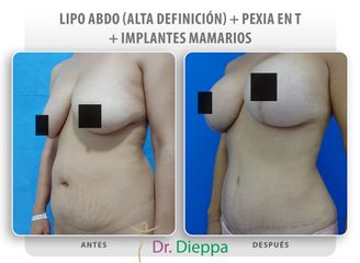 Abdominoplastia - Cirugía Plástica Dieppa