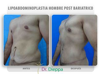 Lipo-abdominoplastia post cirugía bariátrica - Cirugía Plástica Dieppa