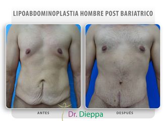 Lipo-abdominoplastia post cirugía bariátrica - Cirugía Plástica Dieppa