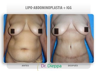 Lipo-abdominoplastia - Cirugía Plástica Dieppa