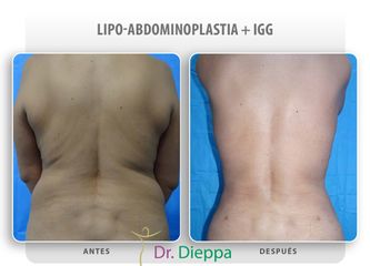 Lipo-abdominoplastia - Cirugía Plástica Dieppa
