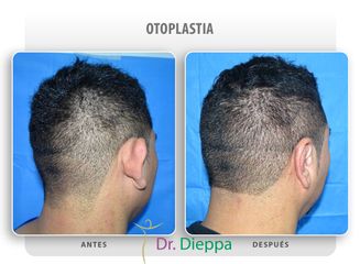 Otoplastia - Cirugía Plástica Dieppa
