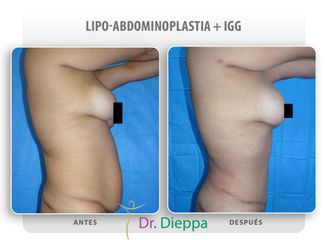 Lipo-abdominoplastia - Cirugía Plástica Dieppa