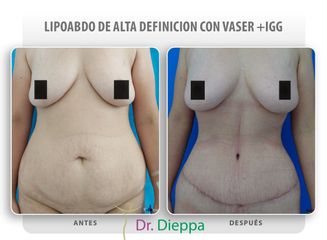 Lipo-abdominoplastia - Cirugía Plástica Dieppa
