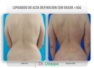 Lipo-abdominoplastia - Cirugía Plástica Dieppa