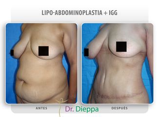 Lipo-abdominoplastia - Cirugía Plástica Dieppa