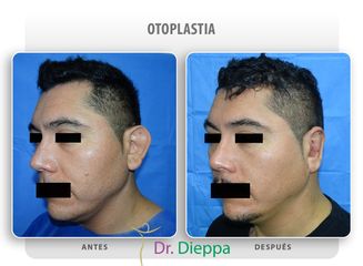 Otoplastia - Cirugía Plástica Dieppa