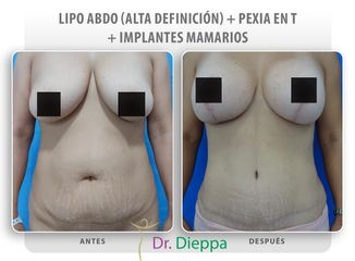 Lipo - abdominoplastia + pexia en T + implantes mamarios - Cirugía Plástica Dieppa