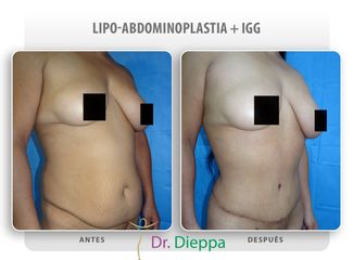 Lipo-abdominoplastia - Cirugía Plástica Dieppa