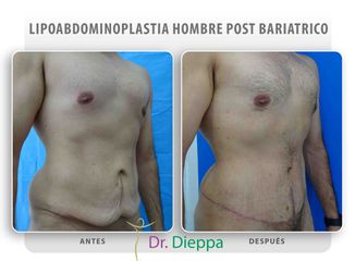 Lipo-abdominoplastia - Cirugía Plástica Dieppa
