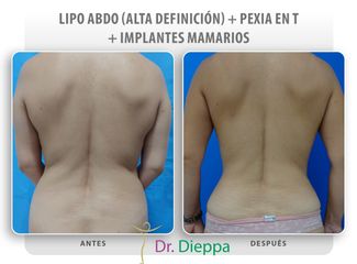 Lipo - abdominoplastia + pexia en T + implantes mamarios - Cirugía Plástica Dieppa