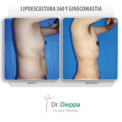 Lipoescultura Masculina - Cirugía Plástica Dieppa
