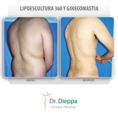 Lipoescultura - Cirugía Plástica Dieppa