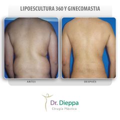 Lipoescultura Masculina - Cirugía Plástica Dieppa