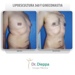 Ginecomastia - Cirugía Plástica Dieppa