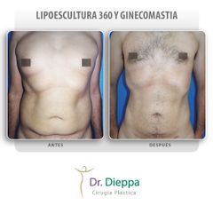 Lipoescultura y Ginecomastia - Cirugía Plástica Dieppa