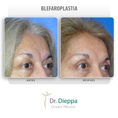 Blefaroplastia - Cirugía Plástica Dieppa