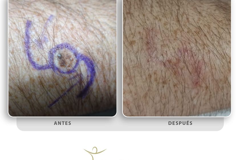 Lunares antes y después - 847482