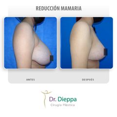Reducción mamaria - Cirugía Plástica Dieppa