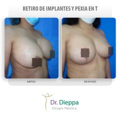 Retiro de implantes - Cirugía Plástica Dieppa