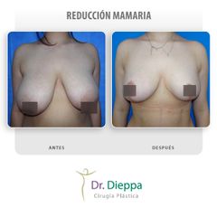 Reducción mamaria - Cirugía Plástica Dieppa