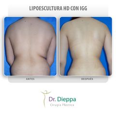 Lipoescultura HD - Cirugía Plástica Dieppa