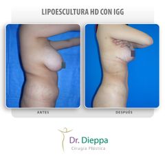 Lipoescultura HD - Cirugía Plástica Dieppa