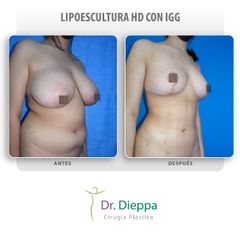 Lipoescultura - Cirugía Plástica Dieppa