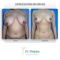 Lipoescultura HD - Cirugía Plástica Dieppa