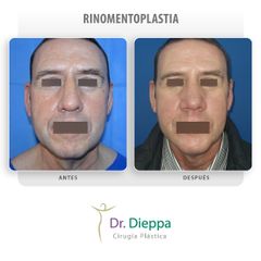 Rinomentoplastia  - Cirugía Plástica Dieppa
