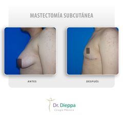 Mastectomía subcutánea  - Cirugía Plástica Dieppa
