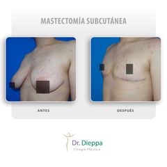 Mastectomía subcutánea  - Cirugía Plástica Dieppa