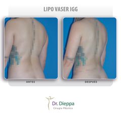 Lipo Vaser IGG  - Cirugía Plástica Dieppa