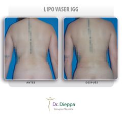 Lipo Vaser IGG - Cirugía Plástica Dieppa