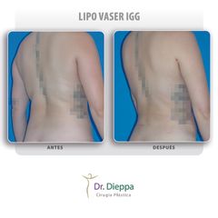 Lipo Vaser IGG  - Cirugía Plástica Dieppa