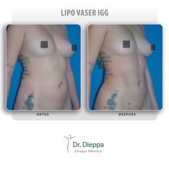 Lipo Vaser IGG  - Cirugía Plástica Dieppa