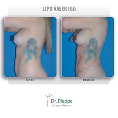 Lipo Vaser IGG - Cirugía Plástica Dieppa