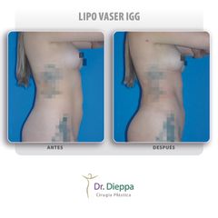 Lipo Vaser IGG - Cirugía Plástica Dieppa