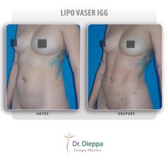 Lipo Vaser IGG  - Cirugía Plástica Dieppa